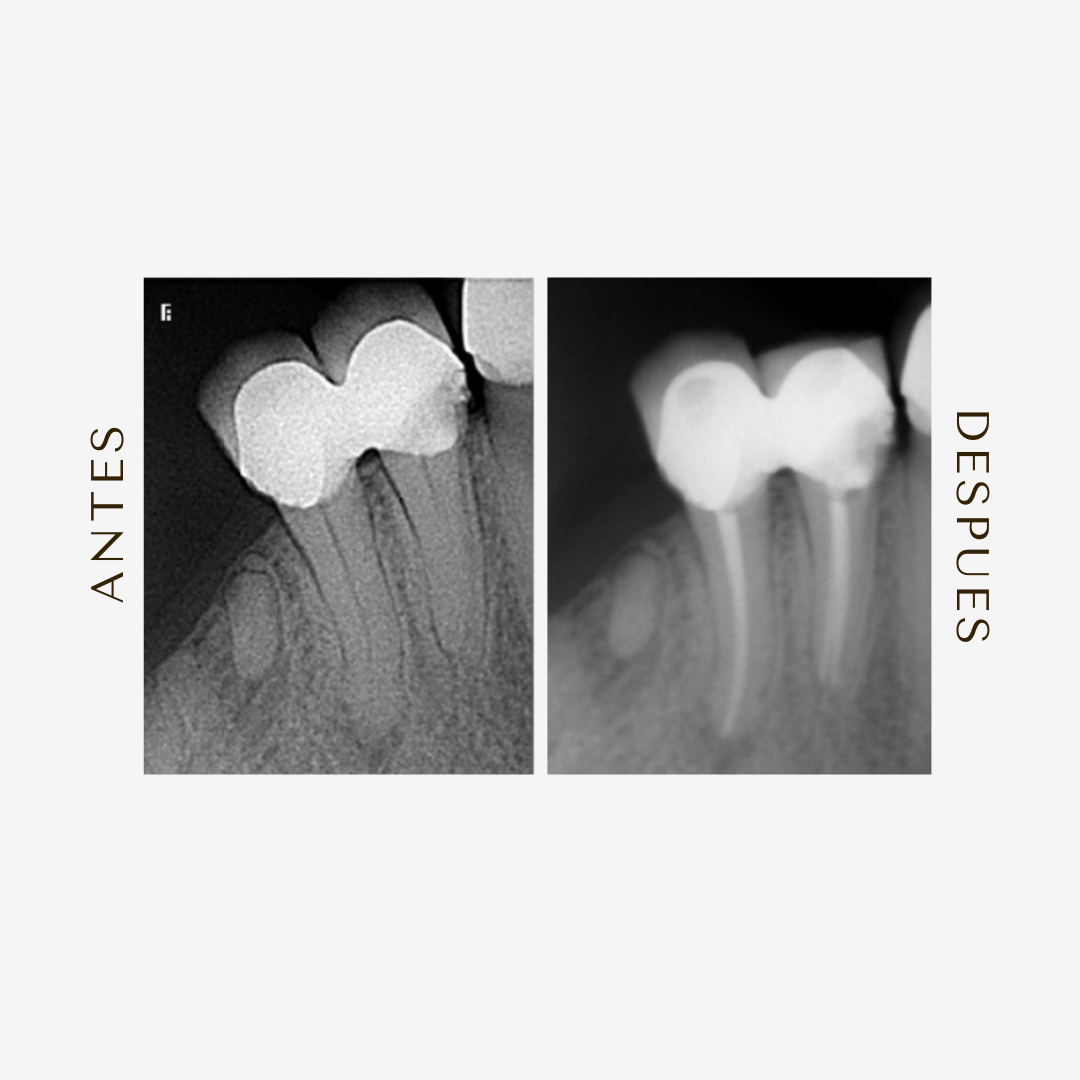 Conductos Necrosados