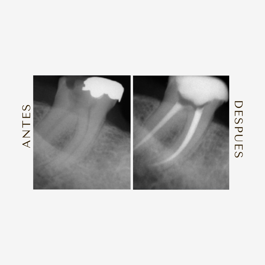 Tratamiento en Raíces Curvas