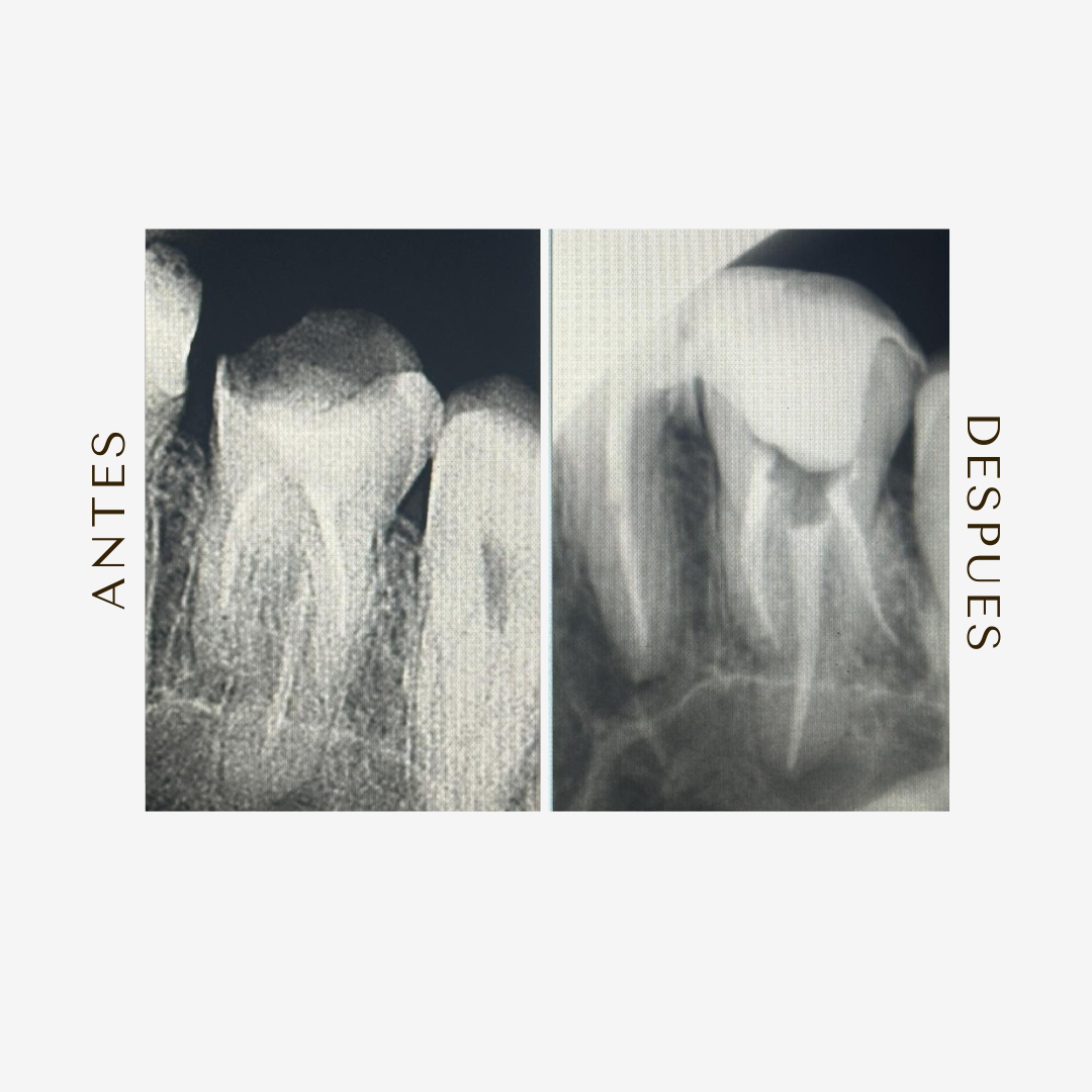 Retratamiento Endodóntico
